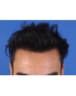 After Hair Transplant Front
